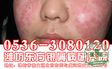 银屑病受伤后该怎样处理伤口呢？