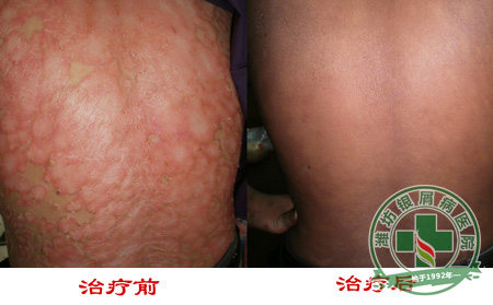 粘膜型银屑病症状常见于哪些部位？