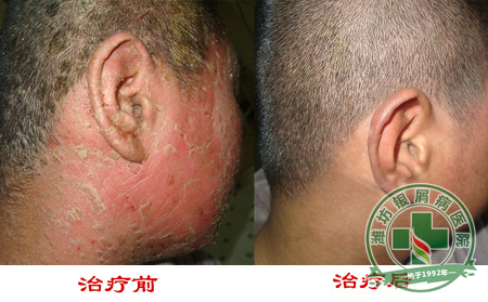 银屑病复发直接原因包括缺水吗？