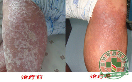 全面概述：关节型银屑病