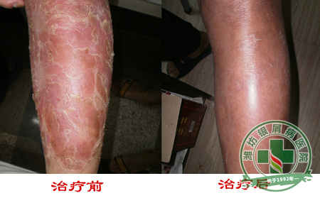 牛皮癣红斑变大是病情加重吗?