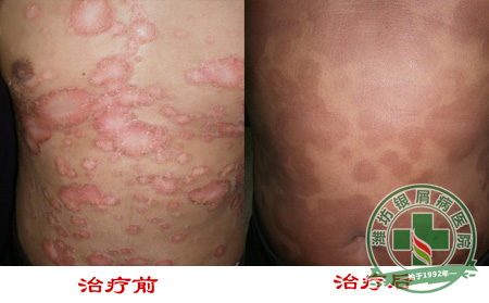 银屑病的引发与性格有关联?