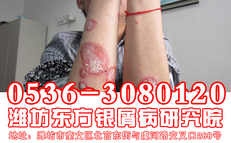 牛皮癣患者如何做到营养均衡?