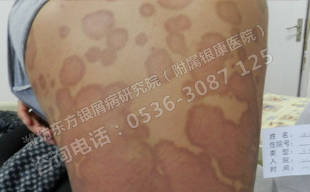 牛皮癣治疗,治疗牛皮癣,牛皮癣注意什么