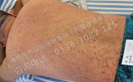 牛皮癣患者在治疗的时候要注意的事情