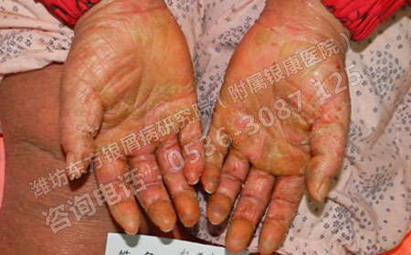 顽固性银屑病的特效治疗药物有哪些