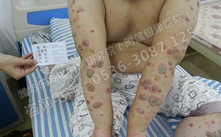 寻常型银屑病患者怎样减少银屑病复发呢