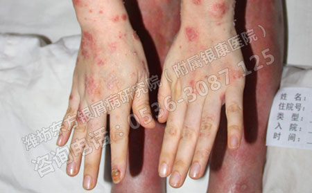 女性银屑病患者吃什么可以护理肌肤