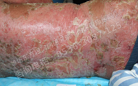 哪种治疗银屑病的方法更好