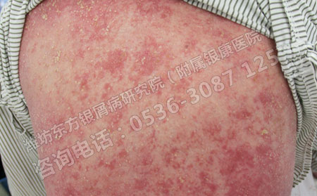 牛皮癣会传染给亲密的人吗