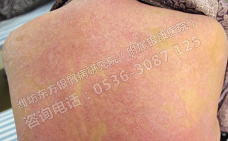 济南睡眠不足会不会引发银屑病？ 