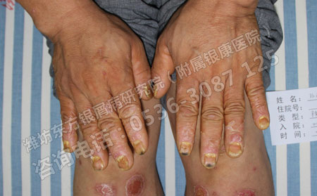 银屑病患者在怀孕期间应该注意哪些问题?