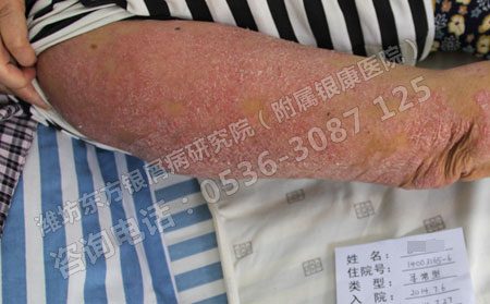 银屑病患者进行体育锻炼对银屑病有没有影响？
