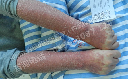 夏季银屑病患者吃点什么有利于银屑病的康复？