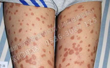 银屑病患者养宠物会不会影响银屑病的病情？