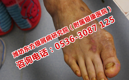 儿童患上牛皮癣怎么办