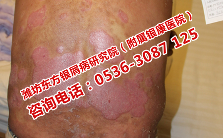济南看牛皮癣哪家医院效果好
