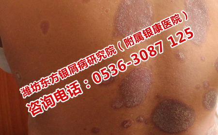 牛皮癣复发了有什么后果