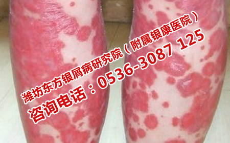 儿童牛皮癣患者哪些食物不能吃