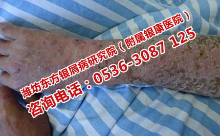 牛皮癣怎样治疗最有效