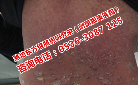 牛皮癣患者哪些食物不能吃