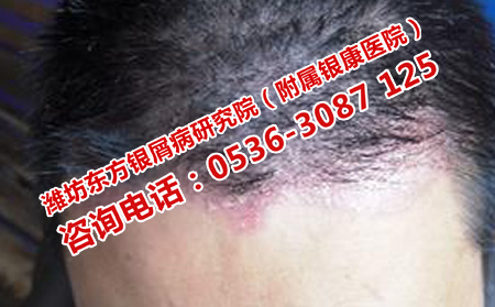 头部牛皮癣需要注意什么问题