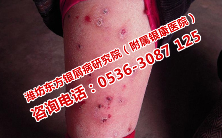 如何避免患上牛皮癣