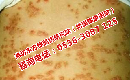 如何规范使用药物治疗牛皮癣
