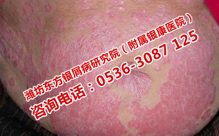什么方法避免牛皮癣二次复发