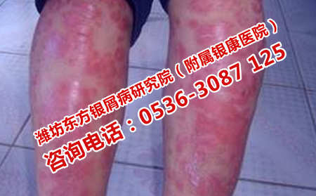 济南治疗牛皮癣好的医院