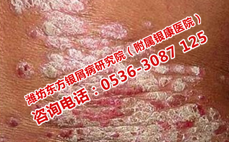 脓疱型银屑病传染吗
