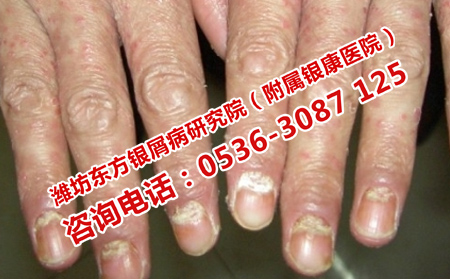 济南中医辨证治疗银屑病