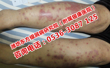 银屑病破损后会传染吗