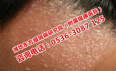 济南银屑病医院手术治疗