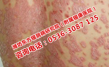 频繁复发的银屑病该怎么办