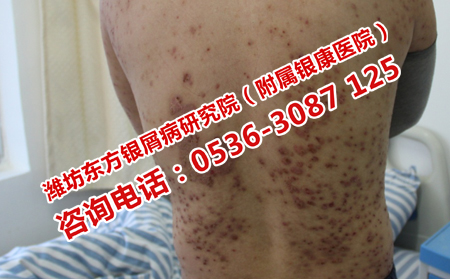 遗传性银屑病何时发病