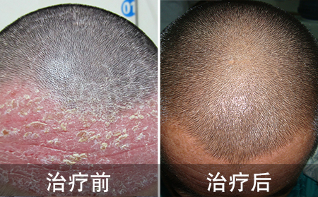 治好多年头部银屑病的案例