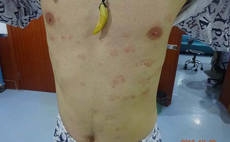 牛皮癣患者身体不舒服吃不下饭怎么办