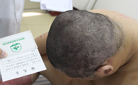 牛皮癣隔代遗传