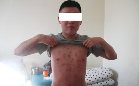 运动护理银屑病